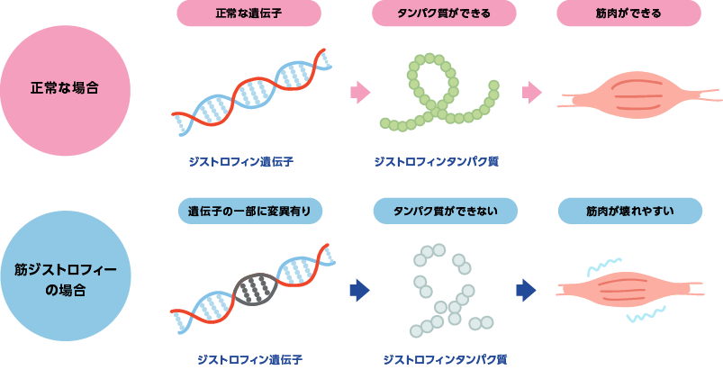 ジストロフィン遺伝子の変異