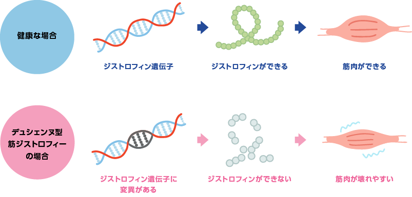 デュシェンヌ型筋ジストロフィーとは