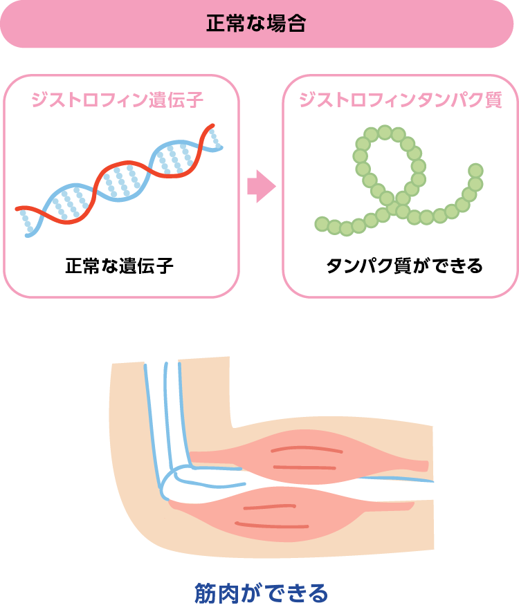 筋ジストロフィーとは Dmdを知る 日本新薬株式会社