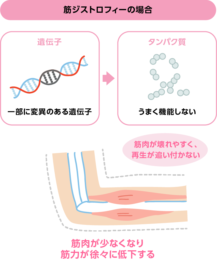 筋ジストロフィーの場合