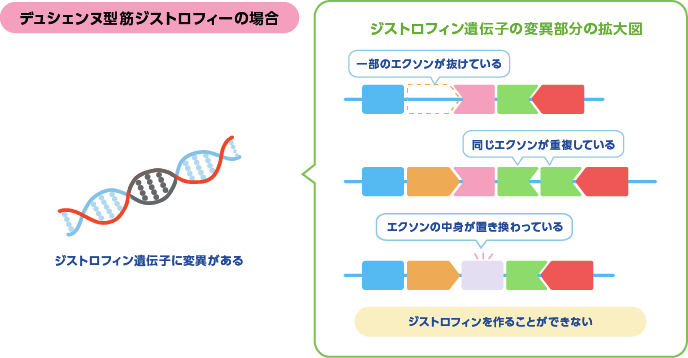 デュシェンヌ型筋ジストロフィーの場合