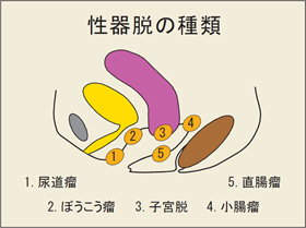 女性の尿失禁と骨盤臓器脱について 患者さん・ご家族の皆さまへ
