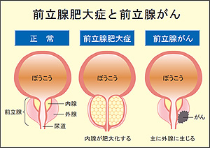 前立腺がんと排尿障害について 患者さん ご家族の皆さまへ 日本新薬株式会社