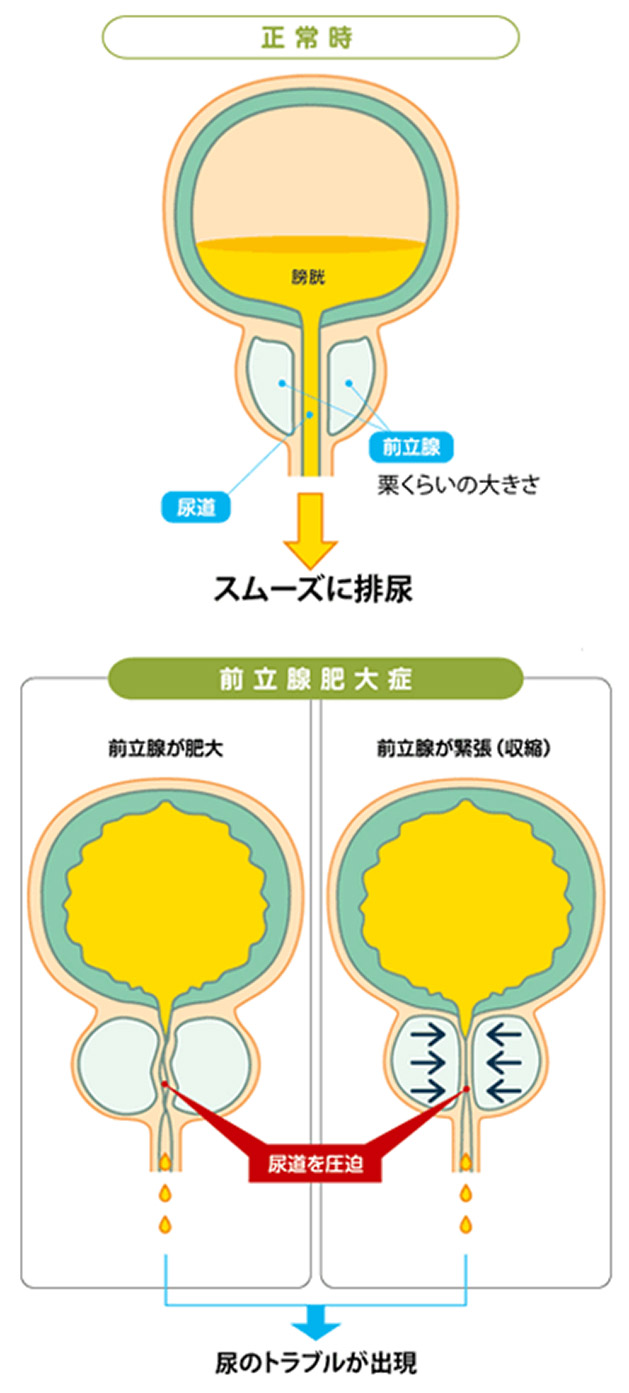 前立腺 肥大 予防