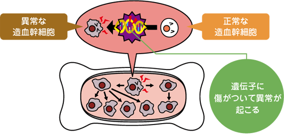 骨髄異形成症候群（MDS）とは