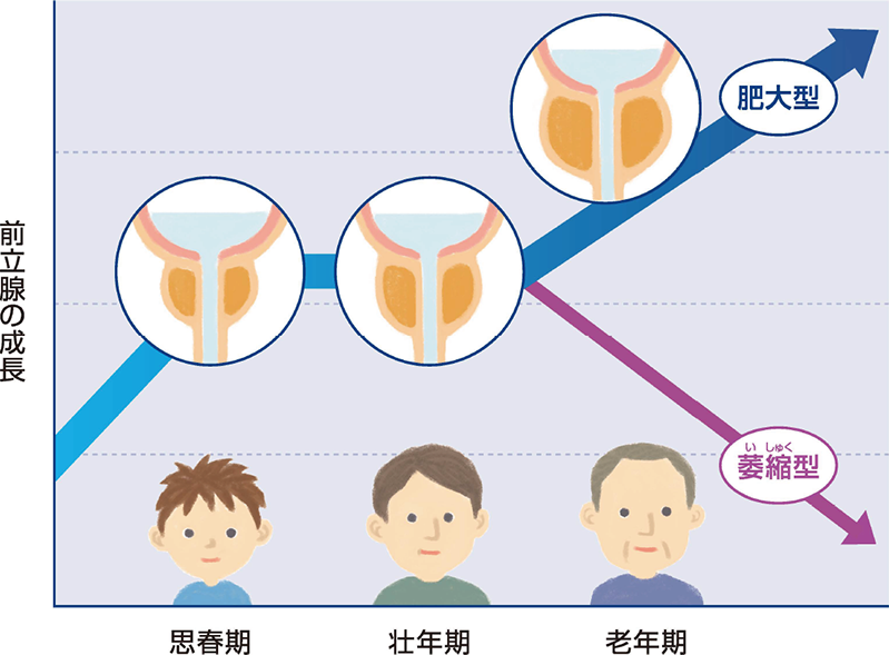 前立腺と年齢の関係