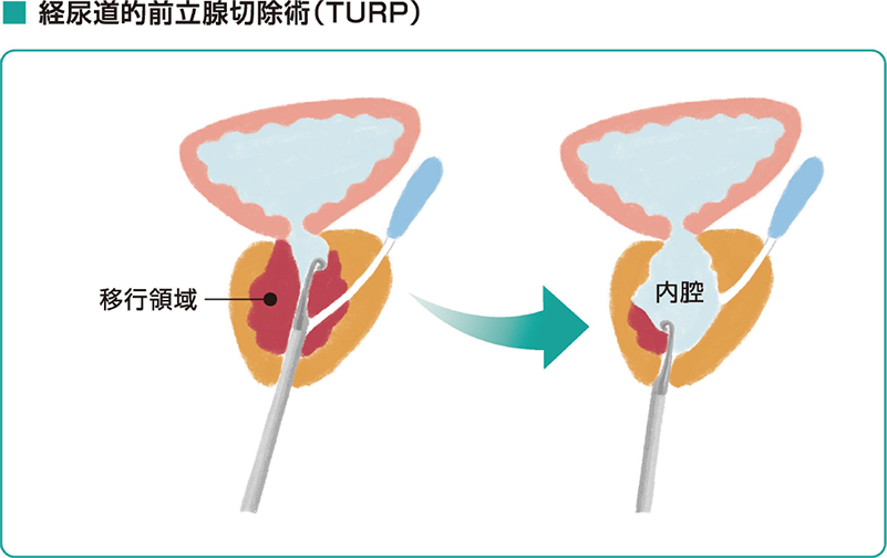 経尿道的前立腺切除術(TURP)