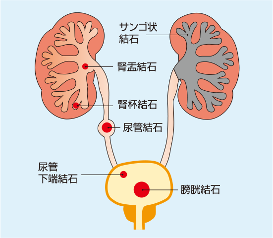 尿路結石とは