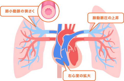右心室の拡大や肺小動脈の狭さく肺動脈圧の上昇